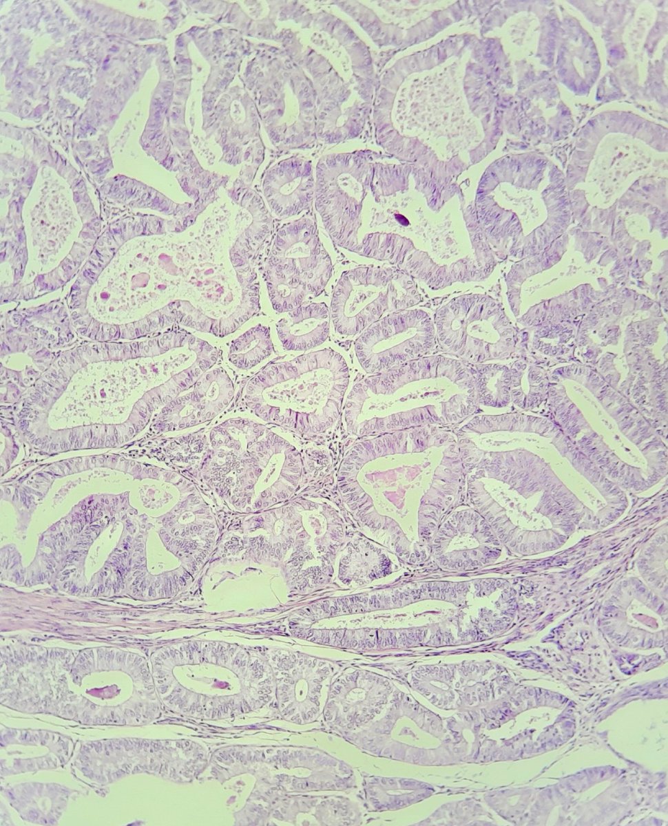 pathognosis22's tweet photo. #Case29 Endometrioid endometrial carcinoma : invasion defined loss of intervening stroma, solid <5% Garde 1, nuclear feature intermediate (H2)- not recommended,myometrial invasion <50% ,IHC in same thread #gynepath #pathtwitter #pathology #pathforlife #pathArt https://t.co/inWDZjSZxi