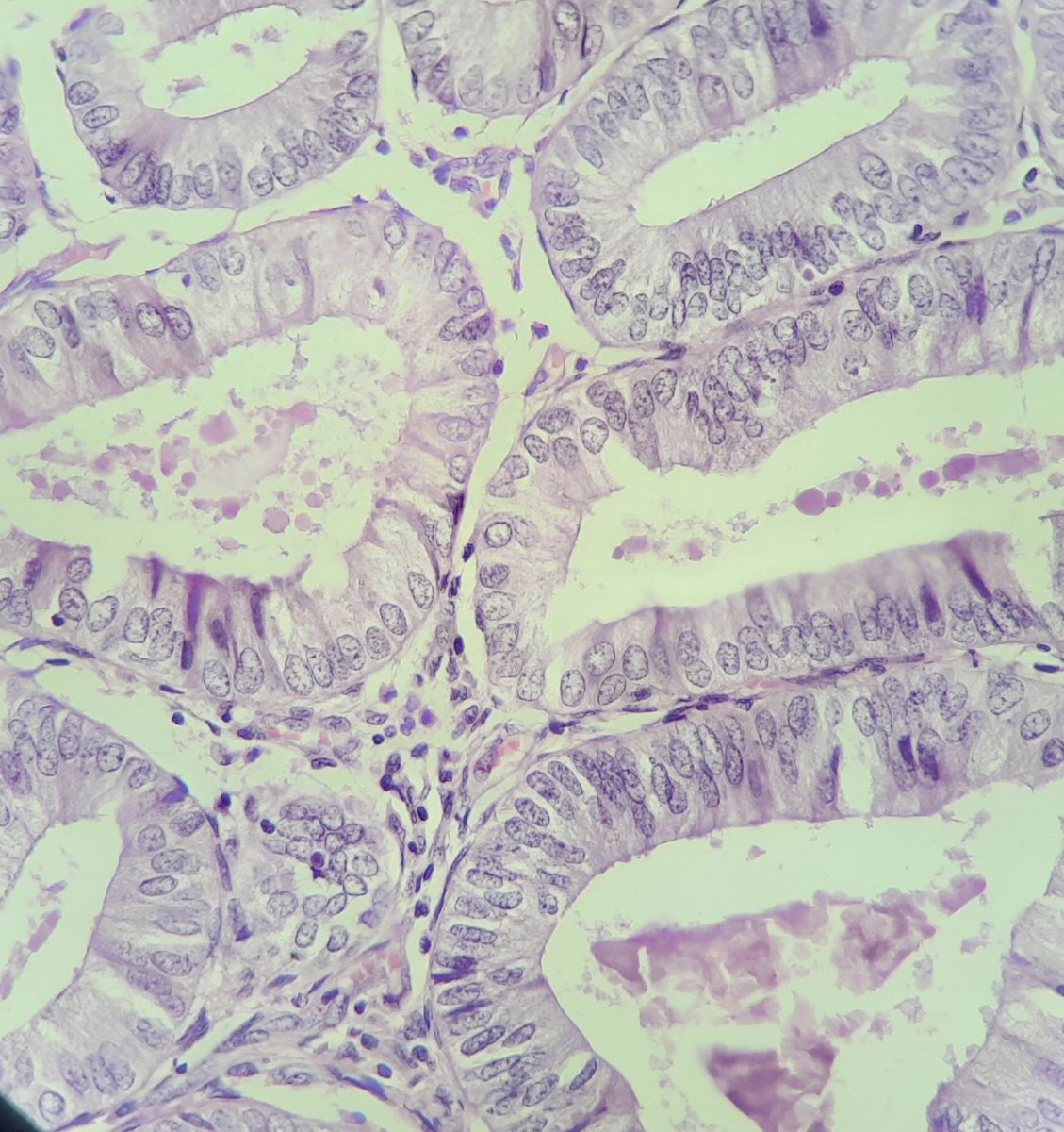 pathognosis22's tweet photo. #Case29 Endometrioid endometrial carcinoma : invasion defined loss of intervening stroma, solid <5% Garde 1, nuclear feature intermediate (H2)- not recommended,myometrial invasion <50% ,IHC in same thread #gynepath #pathtwitter #pathology #pathforlife #pathArt https://t.co/inWDZjSZxi