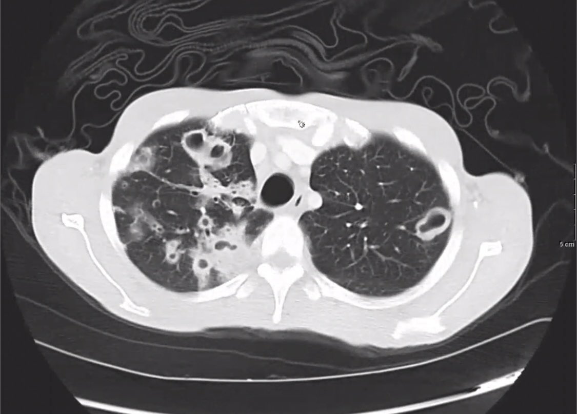 MontefiorePulm's tweet photo. Presenting the highlight from this mornings radiology rounds! @DavidESchecter, 1st year PCCM fellow, reviewing the differential of diffuse bilateral necrotic lung nodules in an immunocompromised patient with @MontefioreRAD #lungs #septicemboli #MedEd #PCCMFellowship https://t.co/rIzJojh1Zh
