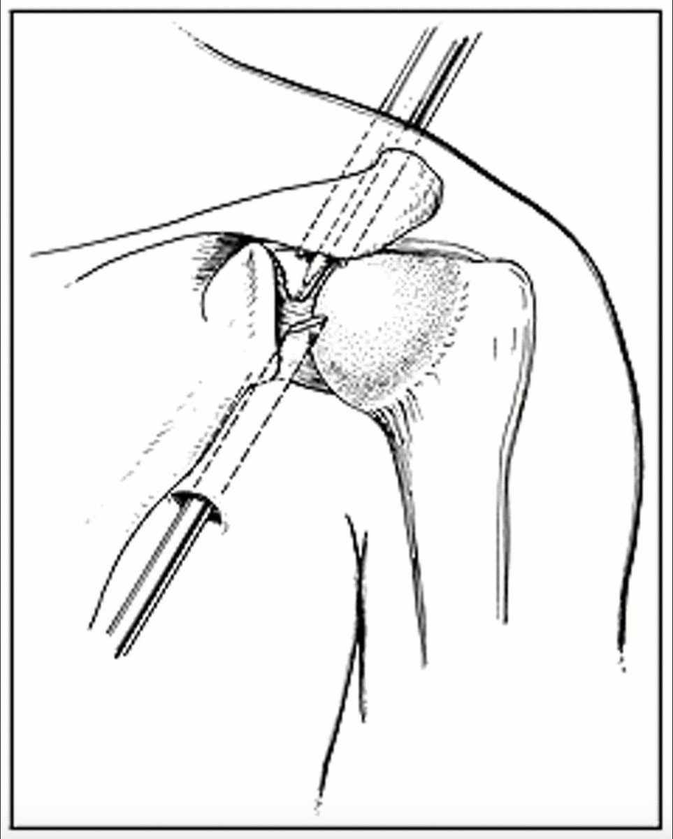 WalkerRo2's tweet photo. Updated #JBJSClinicalSummary on Adhesive Capsulitis by E. Scott Paxton, MD
@escottpaxton
#shoulder #elbow #diabetesmellitus #glenohumeral #vasculitis
https://t.co/sZz0fQUNvS https://t.co/rOATA2qLPj