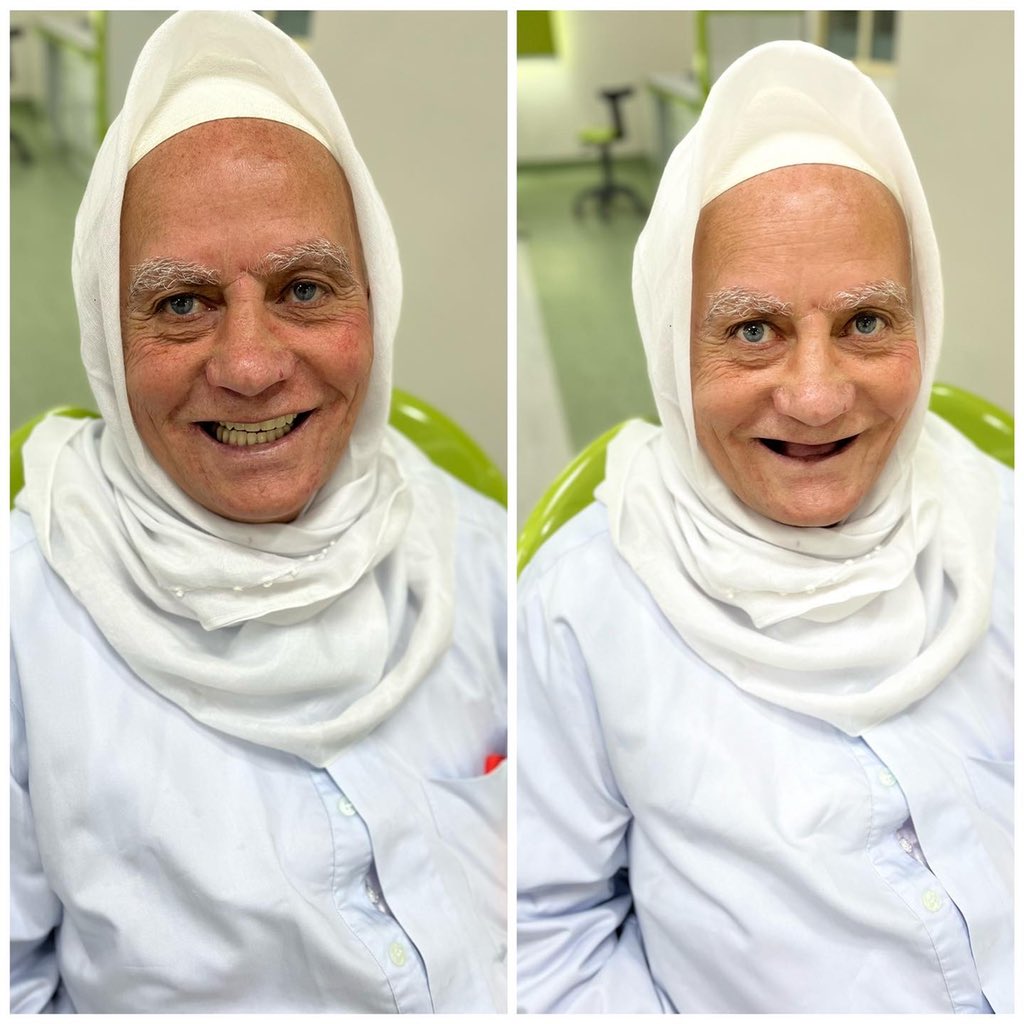 First complete denture 🦷💕