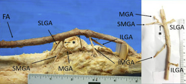 Cadaveric Classification of the Genicular Arteries, with Implications for the Interventional Radiologist @mazsig @AbinSajanMD ow.ly/FRcU50Izhj7 #irad #jvir