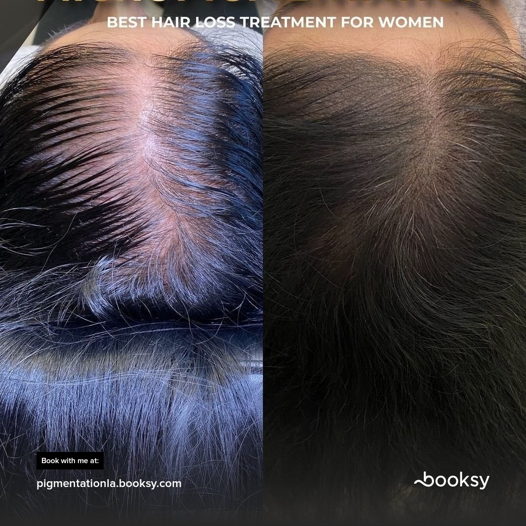 mannyllaves's tweet photo. https://t.co/2VmTbcNl2v
#alopecia #hairloss #hairtattoo #haittattoo #micropigmentation #pigmentation #onlinebooking #scalp #scalpmicropigmentation #smp #fyp #trending #booksy https://t.co/Tt6gTqctQN