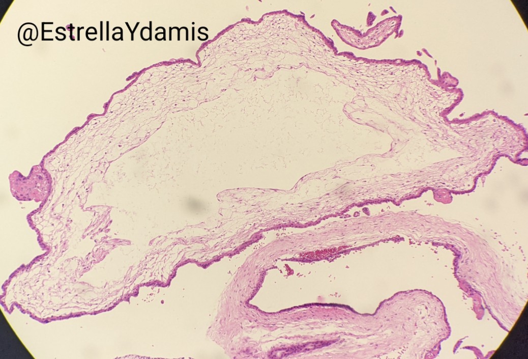 Dysmorphic villi with irregular contours, trophoblast inclusions, and villous cisterns #placenta #pedipath