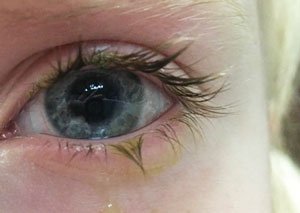 revoptom's tweet image. Mild Adverse Events Common in Young Contact Lens Wearers
Cases were unlikely to be severe or cause discontinuation of use.
reviewofoptometry.com/article/mild-a…
#contactlens #cornea #optometry #contactlenses #eyecare #optician