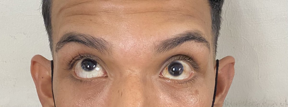 01_menchaca's tweet photo. Lo que provoca un puñetazo 🤜🏻 en el ojo 👁 después de un asalto.
Abro hilo…….
#cirugiaplastica
#cirugiamacilofacial
#HCFA
#residencia. https://t.co/sl9FNfchEZ