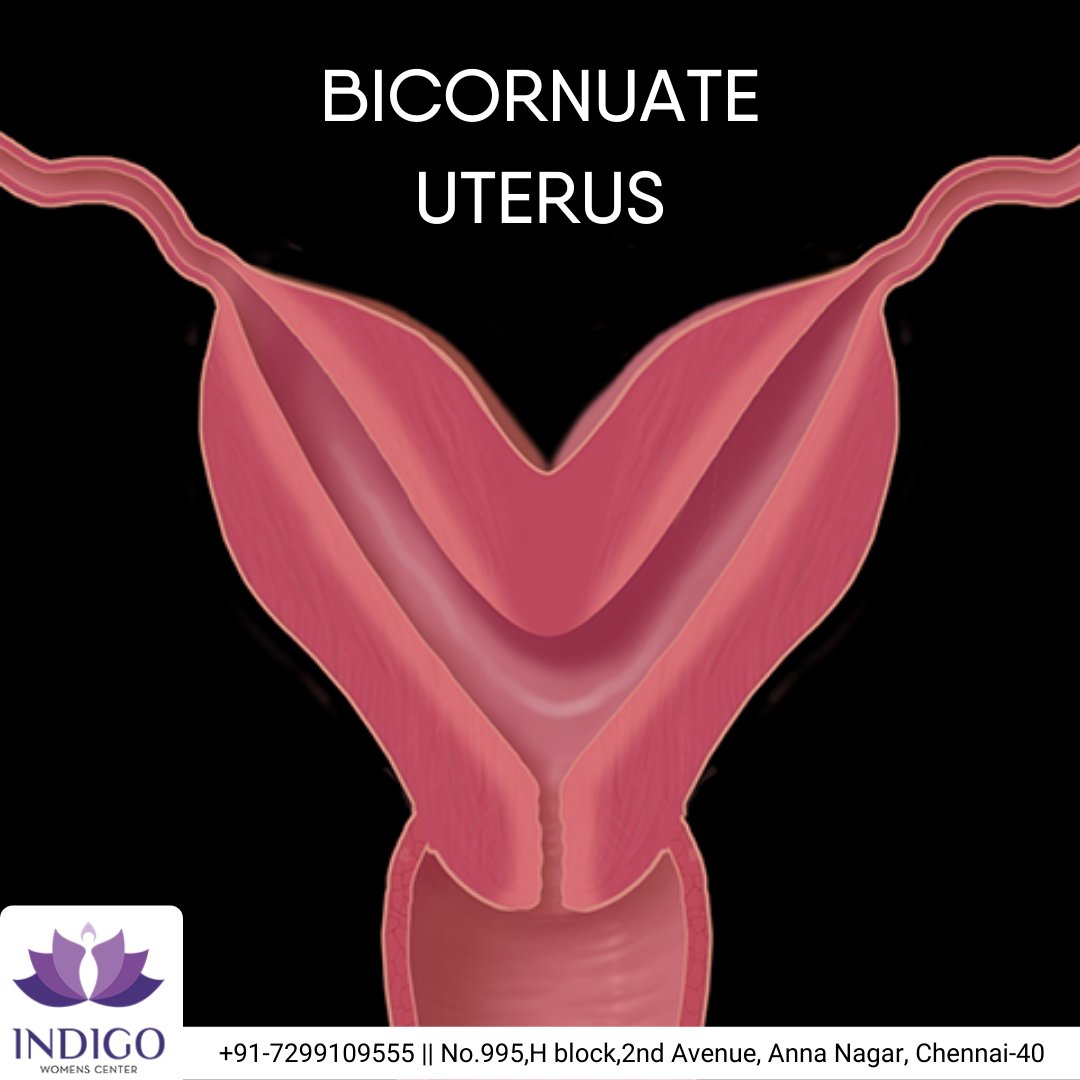 Indigowc's tweet photo. A bicornuate uterus is a uterine malformation that is produced due to impairment in the fusion of Mullerian ducts.
To know more:
https://t.co/K1XcLasvkS
#bicornuateuterus #indigowomensfertilitycenter #womenscare #infertility #fertility #drsurakshithbattina https://t.co/Cb1WqojC8O