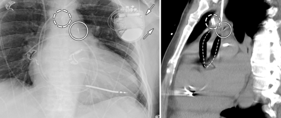 RadiologyCTI's tweet image. NEW PUBLICATION
📜 Radiology of Intra-Aortic Balloon Pump Catheters
🔹Understanding IABP markers and route of placement  seen on radiographs is necessary to ensure appropriate positioning, unlike in this malpositioned axillary-approach IABP
⛓️doi.org/10.1148/ryct.2…