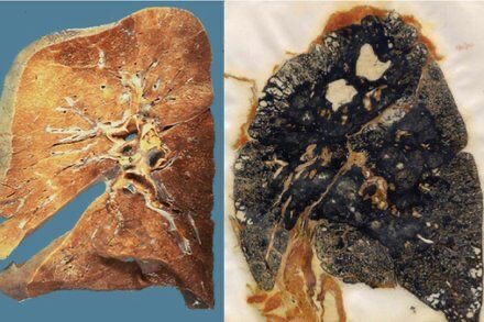 فکر میکنید تصاویر زیر را تحت عنوان ریهٔ فرد سیگاری سرچ کردم؟ خیر. این عکسها مقایسهٔ ریهٔ فرد سالم در کنار ریهٔ کارگر معدن ذغال‌سنگ است. 
#BlackLungDisease #pneomonia #COPD #Lungs #miners #mineWorkers