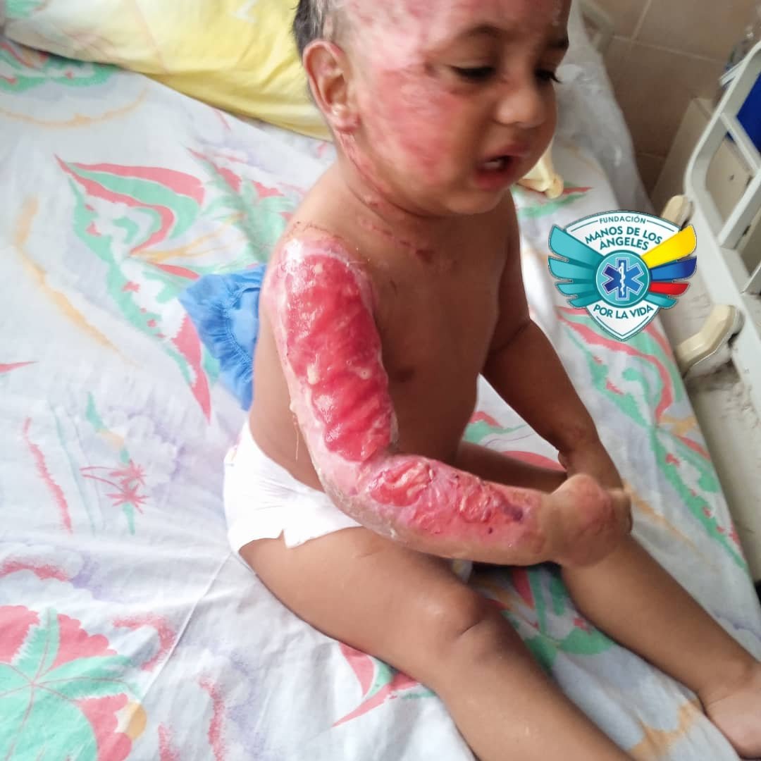 manosdlsangeles's tweet photo. EL BEBE RODRIGO CAMEJO DE 1 AÑO
CUANDO POSTERIOR A EXPLOSION DE BOMBONA DE GAS EN ESPACIO CEF QUEMADURA EN AREAS ESPECIALES CARA Y CUELLO, ADEMAS SE EVIDENCIA QUEM DERECHO POR ESTE MOTIVO ACUDE AL CENTRO EN DONDE POSTERIOR A EVALUACIÓN INGRESO EL 07/02/22 QUIEN SE ENCUENTRA https://t.co/ytsm3ArRtH