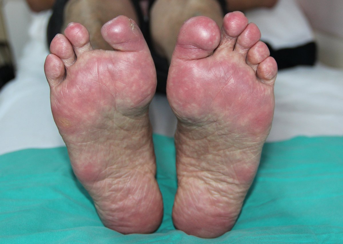 BerivanBitikMD's tweet photo. #Rheumcases 43 years old, male, has EGPA with renal and cardiac involvement, his main problem is probably ADA2 deficiency.  His history of ischemic lesions goes back to his childhood.  He had severe EGPA-associated cardiomyopathy and was on the transplant waiting list. https://t.co/H3c06DUO5B