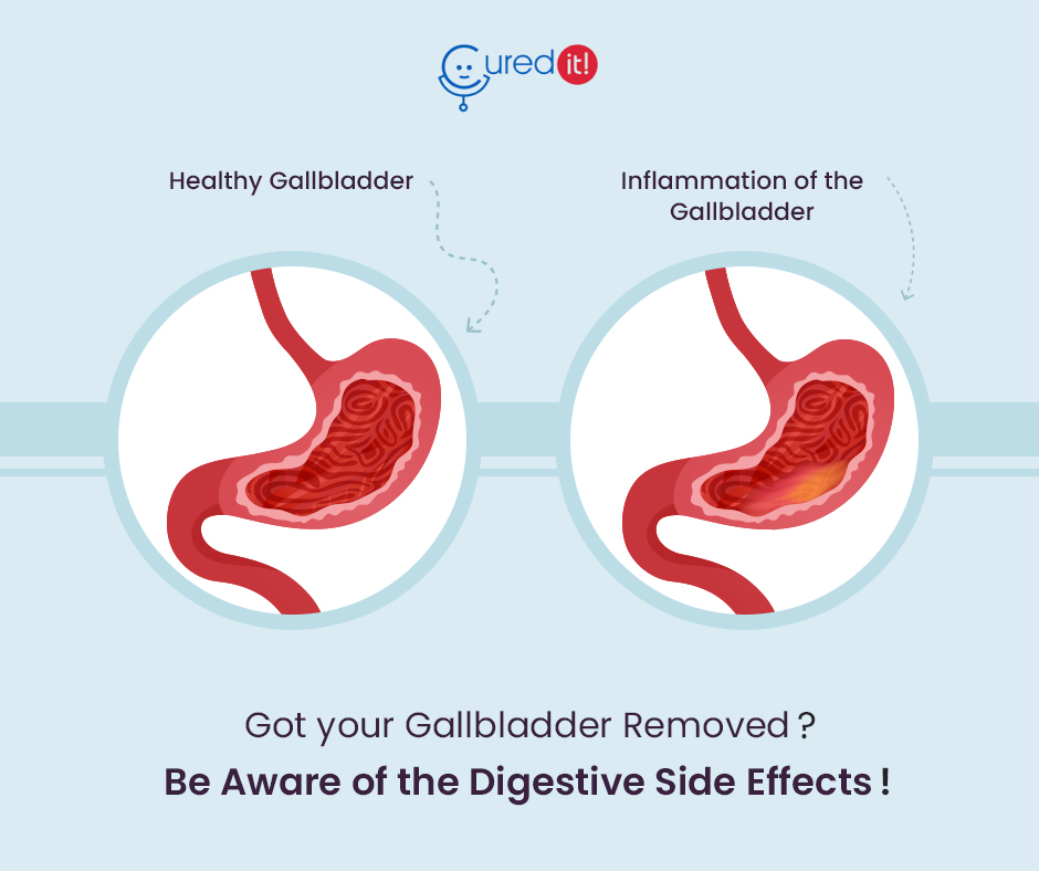 curedit's tweet photo. You may face the following digestive complications after gallbladder surgery.
●Diarrhoea - You may start suffering from diarrhoea right after the surgery.
●Constipation - People use medications after removing their gallbladder. It leads to temporary constipation.
#curedit https://t.co/CMQC2cBc8V