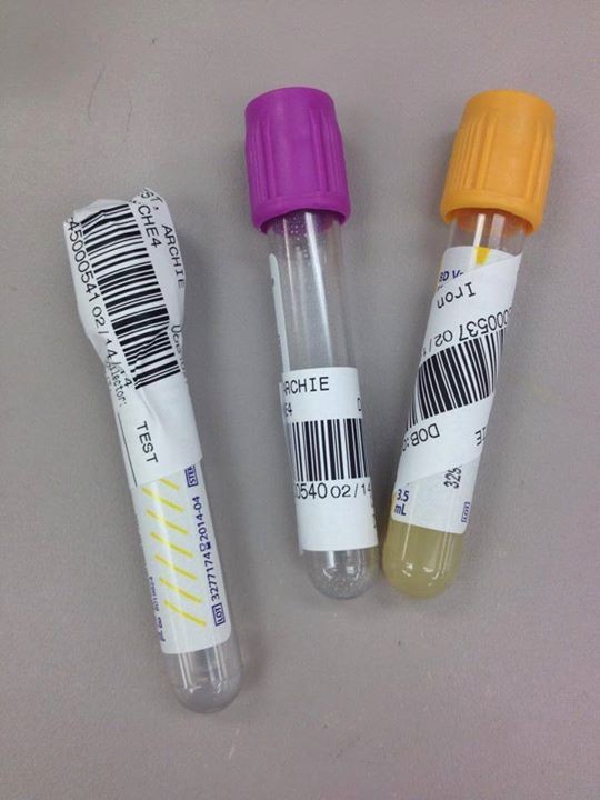 بمناسبة اليوم العالمي للمختبرات الطبيه...

أي عينه عليها باركود بالشكل هذا، سترفض..

فيه إعتبارات لإستقبال العينه اذا كانت متحلله او غير كافيه مثلاً (سب اوبتمل)،
لكن وضع الباركود بهالطريقه غير مقبول...

الزملاء الممرضين : الرجاء التعاون معنا، وكذلك الزملاء في قسم أخذ العينات 👇