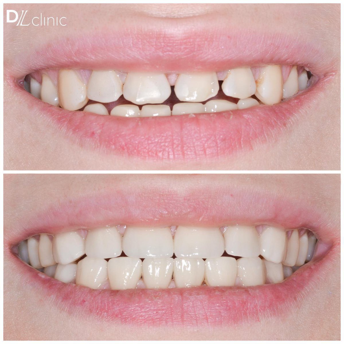 Клинический случай

Пациентка обратилась в <a href="/DL_clinic/">Медицинский центр DLclinic</a> с целью эстетической коррекции зоны улыбки.

Проведено протезирование передних зубов верхней и нижней челюстей. Установлены 2 керамических винира на клыки и 10 керамических коронок на передние зубы.
#стоматологияспб