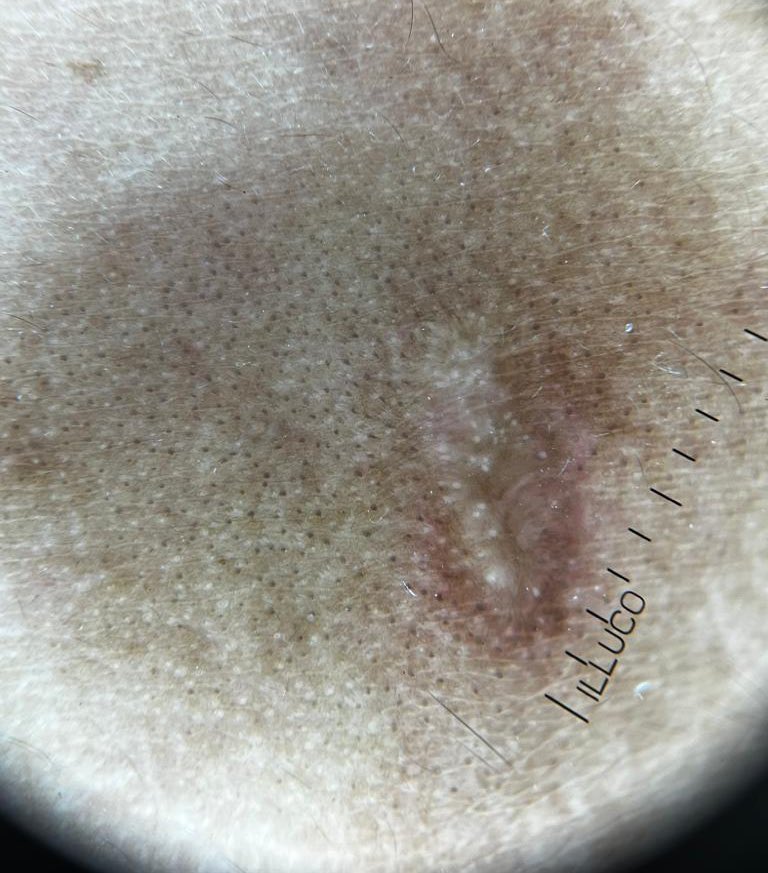 prekaaaaaa's tweet photo. What does this look like?
#dermtwitter #dermatology #dermoscope https://t.co/6PZvYHygxQ