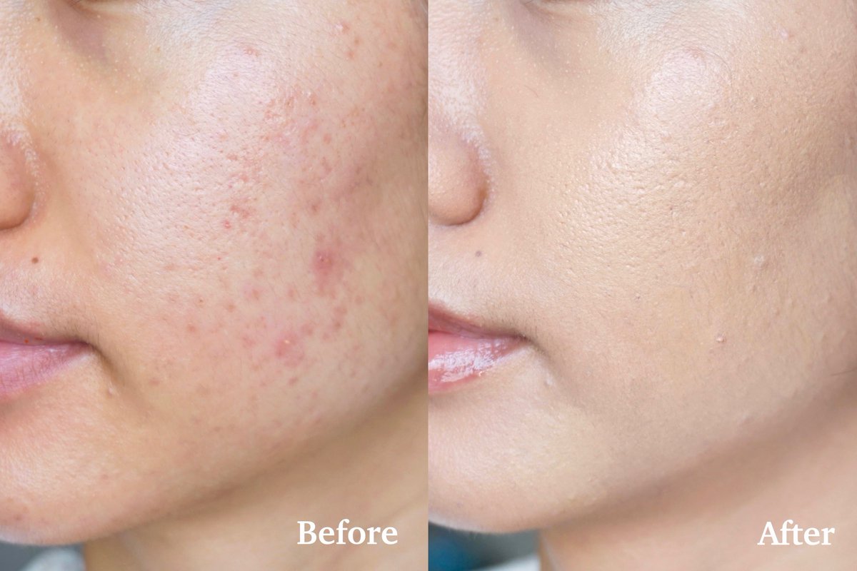 saroreview's tweet photo. ปกปิดแบบปังสุด ต้องยอมนะ กันแดดมิเนอรัลสีเนื้อ #Photoderm CoverTouch ช่วยทั้งป้องกันUVและปกปิดไปในตัว รอยสิวอะไรคือเก็บเรียบหมดจริง สีโทนเหลือง สว่างกว่าผิวแตงนิดนึงแต่โอเคเลยหน้าไม่เทา กันน้ำและเป็น oil free ไม่อุดตัน #Bioderma ออกแบบมาเพื่อคนเป็นสิวอยู่แล้วไว้ใจได้ #รีวิวกันแดด https://t.co/lWhZDpRDJN