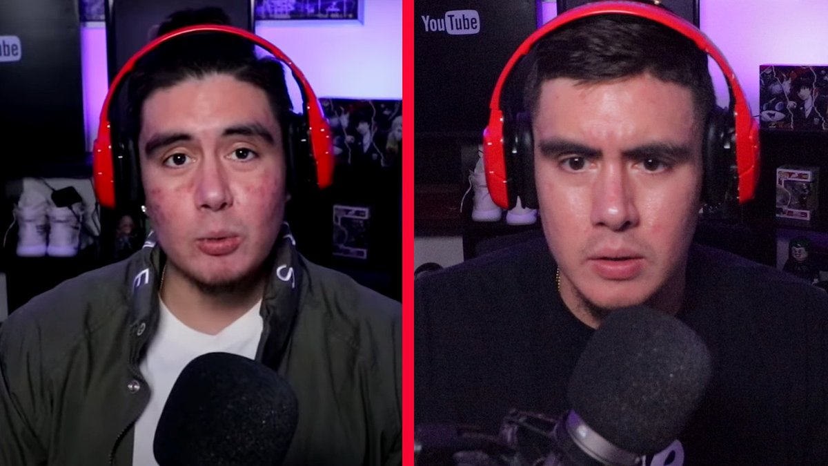 JayKubzScouts's tweet photo. 1 month after seeing the dermatologist and i'm starting to see the changes..still ugly tho https://t.co/cXXaQVdtIF