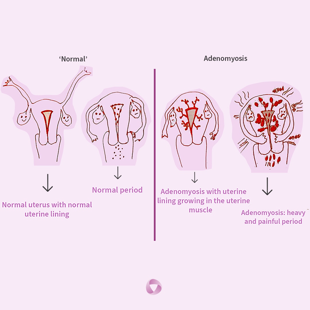 #Adenomyosis is a common yet under-recognised condition that many women unfortunately live with without having a diagnosis.  #AdenomyosisAwarenessMonth