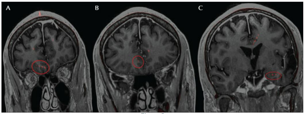 Epileptic Disorders (@epidisorders) on Twitter photo Ictal head roll, a rare semiology, may localize to the right anterior prefrontal region as shown in a patient with longstanding epilepsy due to traumatic brain injury who underwent #SEEG investigation. <a href="/SBeniczky/">Sandor Beniczky</a> <a href="/fabnascimen/">Fábio Nascimento</a> <a href="/RoohiKatyal/">Roohi Katyal</a> bit.ly/3jNjEhT Ictal head roll, a rare semiology, may localize to the right anterior prefrontal region as shown in a patient with longstanding epilepsy due to traumatic brain injury who underwent #SEEG investigation. <a href="/SBeniczky/">Sandor Beniczky</a> <a href="/fabnascimen/">Fábio Nascimento</a> <a href="/RoohiKatyal/">Roohi Katyal</a> bit.ly/3jNjEhT