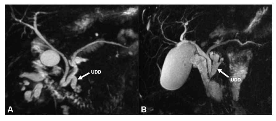 Gio_Marchegiani's tweet photo. For IPMN lovers 🥰 Significance of uncinate duct dilatation 🍇 A new high-risk criterion?

🔪 260 resected IPMN

🌊 Uncinate duct dilatation predicts HGD and IC

🚨 Association persisted for remote IPMNs of dorsal pancreas

@herbert_zeh @Anil_Dasyam 👇👇👇
https://t.co/58SjLt1kl8 https://t.co/eROrvr71In