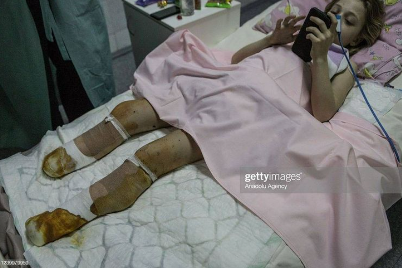 Yana is ten. She’s one of four children who survived and staying in Dnipro hospital. A week ago she was in Kramatorsk train station trying to escape the war when it was hit by russian ballistic missiles. She has lost both her legs. 

SCREAM ABOUT IT!