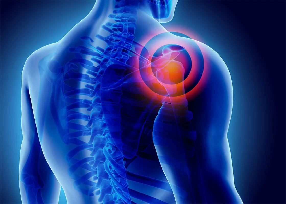 KevinKruseMD's tweet photo. #Biologics can offer health benefits to patients that have #shoulderinjuries. Platelet-rich plasma therapy is an advanced treatment that boosts your body's natural regenerative capacity. Call us at (214) 750-4590. #PRPtherapy #ShoulderDoc #KevinKruseMD https://t.co/aTgUEEg5MB https://t.co/ckTuqQisOH