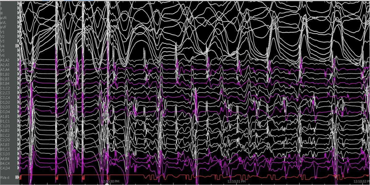 Pasquale Santangeli (@dr_santangeli) on Twitter photo Ablation of recurrent VF in ICM. Beautiful repetitive Purkinje activity at the onset of induced VF <a href="/PennMedicine/">Penn Medicine</a> <a href="/WeeBodeMD/">Weeranun Bode</a> Ablation of recurrent VF in ICM. Beautiful repetitive Purkinje activity at the onset of induced VF <a href="/PennMedicine/">Penn Medicine</a> <a href="/WeeBodeMD/">Weeranun Bode</a>
