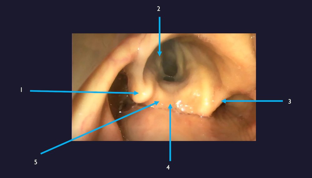 IDEA Series: Reviewing Intubation Video Footage in Conference to Improve Airway Mastery | Advancing resident education through recorded procedures

By Drs. Rauscher, Alexander, <a href="/AlannaOConnell8/">alannaoconnell8</a> from <a href="/BrookdaleEMres/">Brookdale Emergency Medicine Residency</a> 

aliem.com/idea-airway-se…
