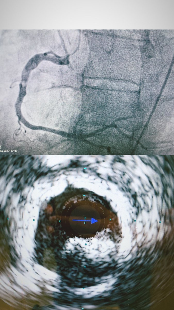 In today’s cath lab adventures, had a focal calcified lesion. 80% stenosis that even IVUS couldn’t pass. Proximal reference diameter is 6mm. Massive lesion with a Mount Everest rock of calcium. What’s your plan? #RadialFirst #femoralactually #CardioTwitter