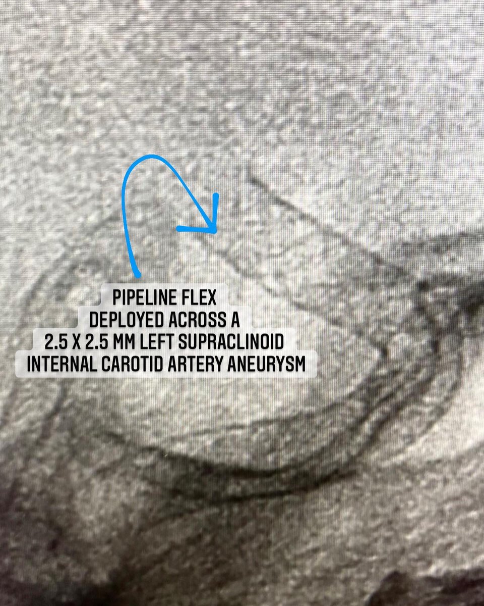 VascNeuro's tweet photo. Complications in neuroendovascular correlate w/ how long you stay inside the vessels. Flow diverters are a game-changer for #brain #aneurysms. Left ICA aneurysm treated with pipeline flex, fluoro time 6.5min. On average these cases take <30mins - groin access to closure. #Neuro https://t.co/QnLkKpLRhm