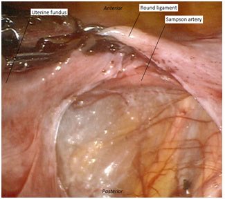 Sampson’s artery is located below the round ligament next to the uterus, and creates an anastomosis between the uterine and ovarian arteries. While physiologically insignificant, injury to this vessel can be a source of bleeding during surgery. 1/2