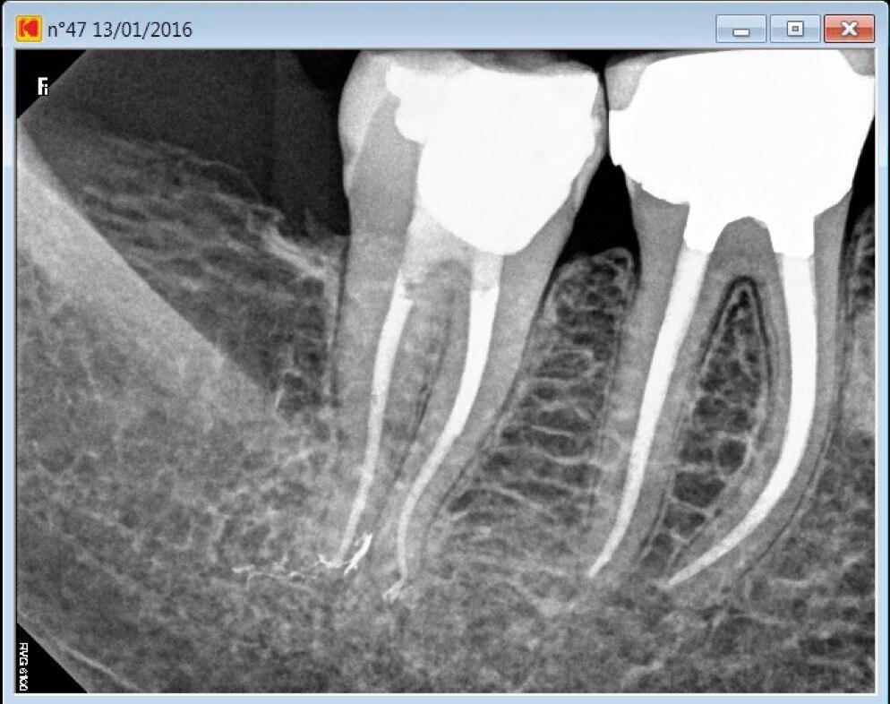 OMDENTALCLINICS's tweet photo. Good start for the day....🙂
Root canal treatment d..For more info visit...https://t.co/uV6BAllq7Q https://t.co/4Wg6MWLuuP