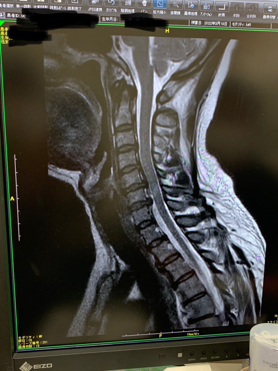 MRIの結果、頸椎5.6.7番神経に触ってるってさ。このまま、薬漬けかもなー😩　最終的には手術しかないそうだ。（そのレベルでないけど (@ さくら通り整形外科 in 葛飾区, 東京都)  