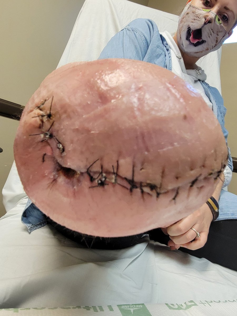 nykkimitchell's tweet photo. There's still a small hole that needs to close up. It could seal up on its own in the next two weeks or we may do a skin graph.
The cat mask is cute though! 

https://t.co/Jluc32sVF2 https://t.co/RWSWPRTwp6