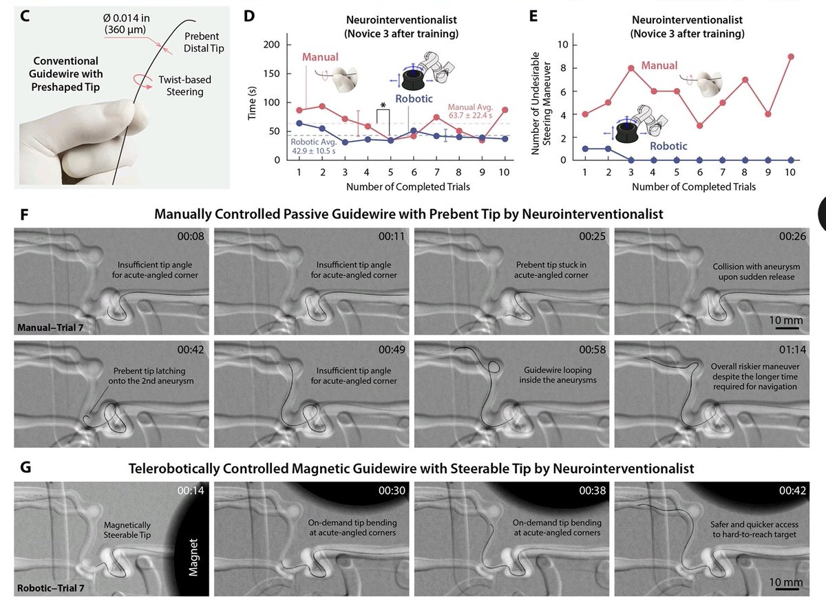 7/n. Better performances. While the neurosurgeon has been trained &gt;4y for manual operation and only ~1h with our robot, the operation time with the robot is shorter. The robot also avoids multiple undesirable steerings which may be intrinsically unavoidable for J guidewires.