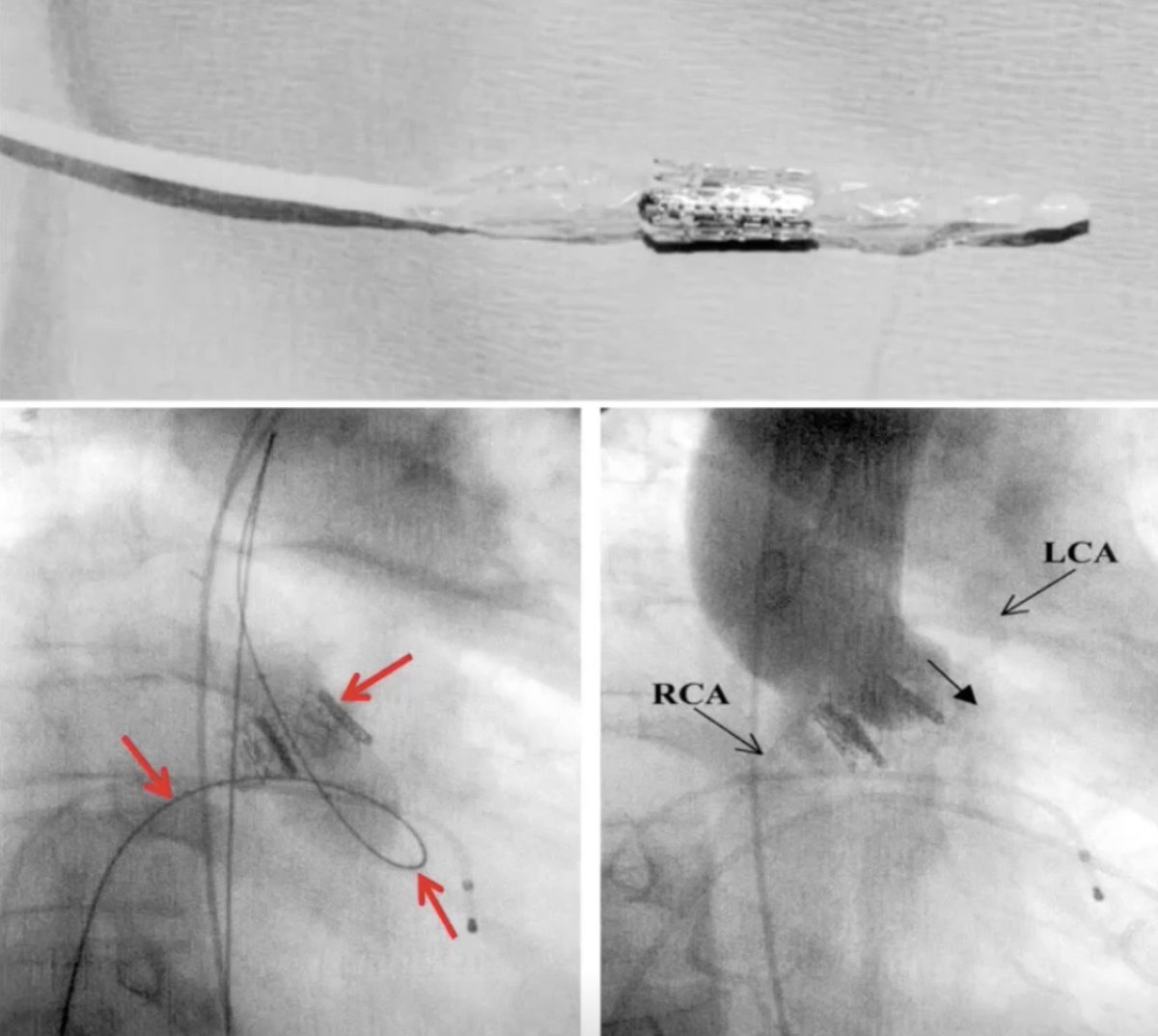 Today, 20 years ago, April 16, 2002, Dr Alain Cribier performed the first #TAVR via venous transseptal approach on a 57 year old male in France with cardiogenic shock with EF 12%. Goal was to live 30 more minutes; Patient lived 4 months and died from noncardiac reasons. #history