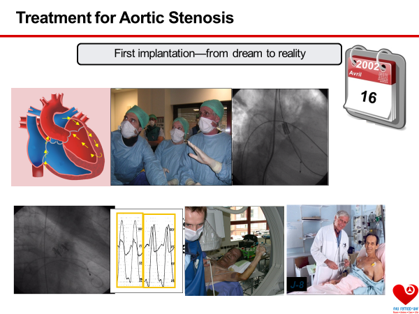 PCRonline's tweet photo. 20 years of #TAVI! 🎉👏🏽

On 16 April 2002 at @Cardio_CHURouen 🇫🇷 @AlainCribier performed the first transcatheter aortic valve replacement procedure in the world. He used a Percutaneous Valve Technology (PVT) percutaneous heart valve. 

Read more https://t.co/UDqNeDCEul #TAVR https://t.co/0XcwnKms1k