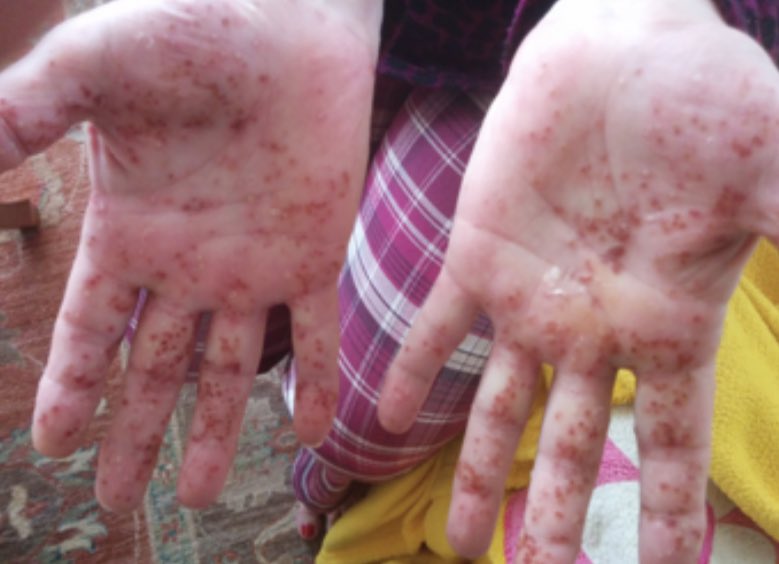 BerivanBitikMD's tweet photo. #RheumCases 63 yo,F, psoriasis rash 2 y ago👇 +, used MTX, diagnosed with localized lymphoma, finished 6 cycles of chemo, 1 year drug-free follow-up, widespread peripheral and axial pain,rashes are currently inactive.  I started NSAIs, I hope it will be enough. #rheumatology https://t.co/M0MkdDdNWt