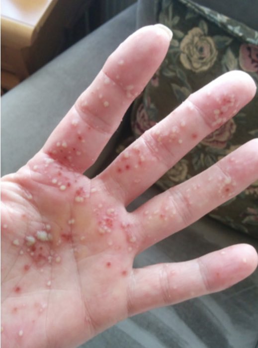 BerivanBitikMD's tweet photo. #RheumCases 63 yo,F, psoriasis rash 2 y ago👇 +, used MTX, diagnosed with localized lymphoma, finished 6 cycles of chemo, 1 year drug-free follow-up, widespread peripheral and axial pain,rashes are currently inactive.  I started NSAIs, I hope it will be enough. #rheumatology https://t.co/M0MkdDdNWt