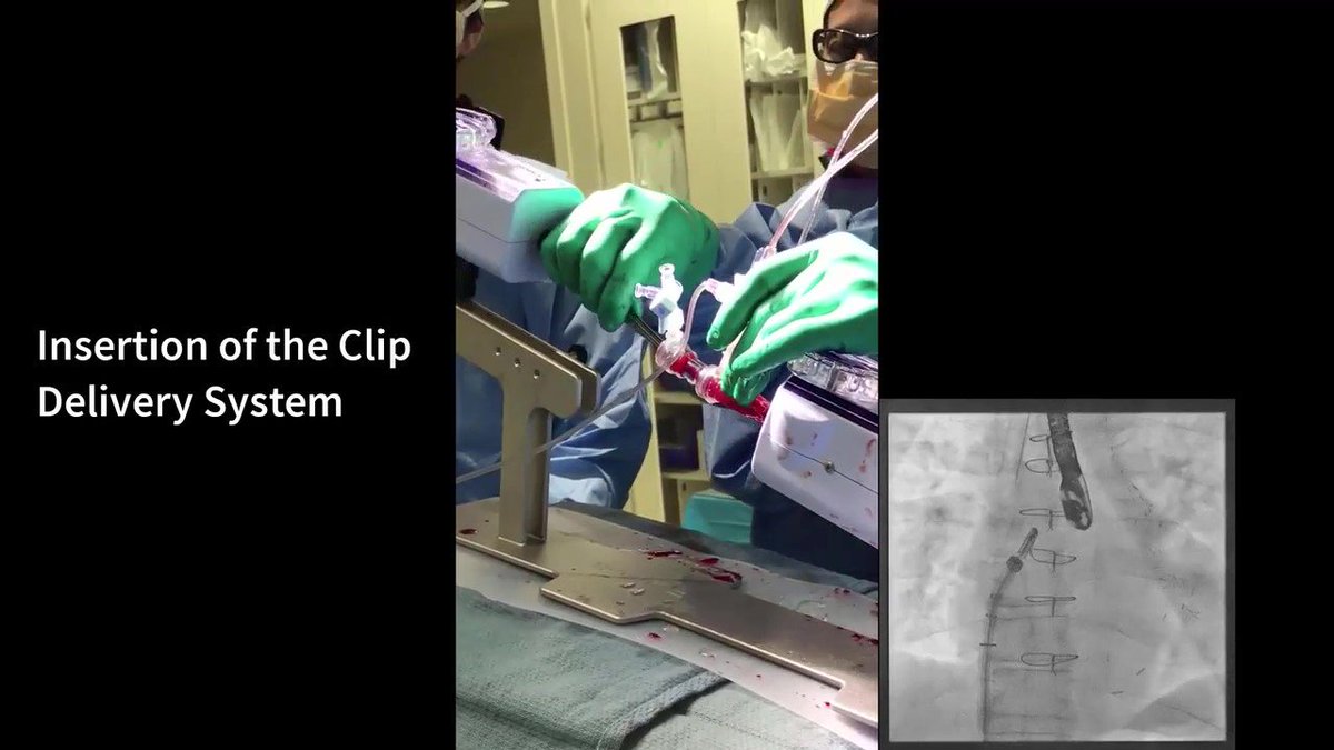 @AATSHQ @tssmn @FYazdchi @GilbertTangMD @tomcnguyen @TsuyoshiKaneko1 Watch the full video by Yazdchi, Kaneko et al in OpTechs: bit.ly/3vp9wkR Transcatheter Edge to Edge MV Repair (MitraClip) Step by Step Guide. #CardioTwitter #CTSurgery @AATSHQ @tssmn @FYazdchi @GilbertTangMD @tomcnguyen @TsuyoshiKaneko1