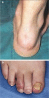 It can be hard to distinguish ENTHESITIS from DACTYLITIS in our minds:
Enthesitis (Top): tender and ligament insertion points. pain with tenderness at these connections

Dactylitis (Bottom): Entire digit swollen