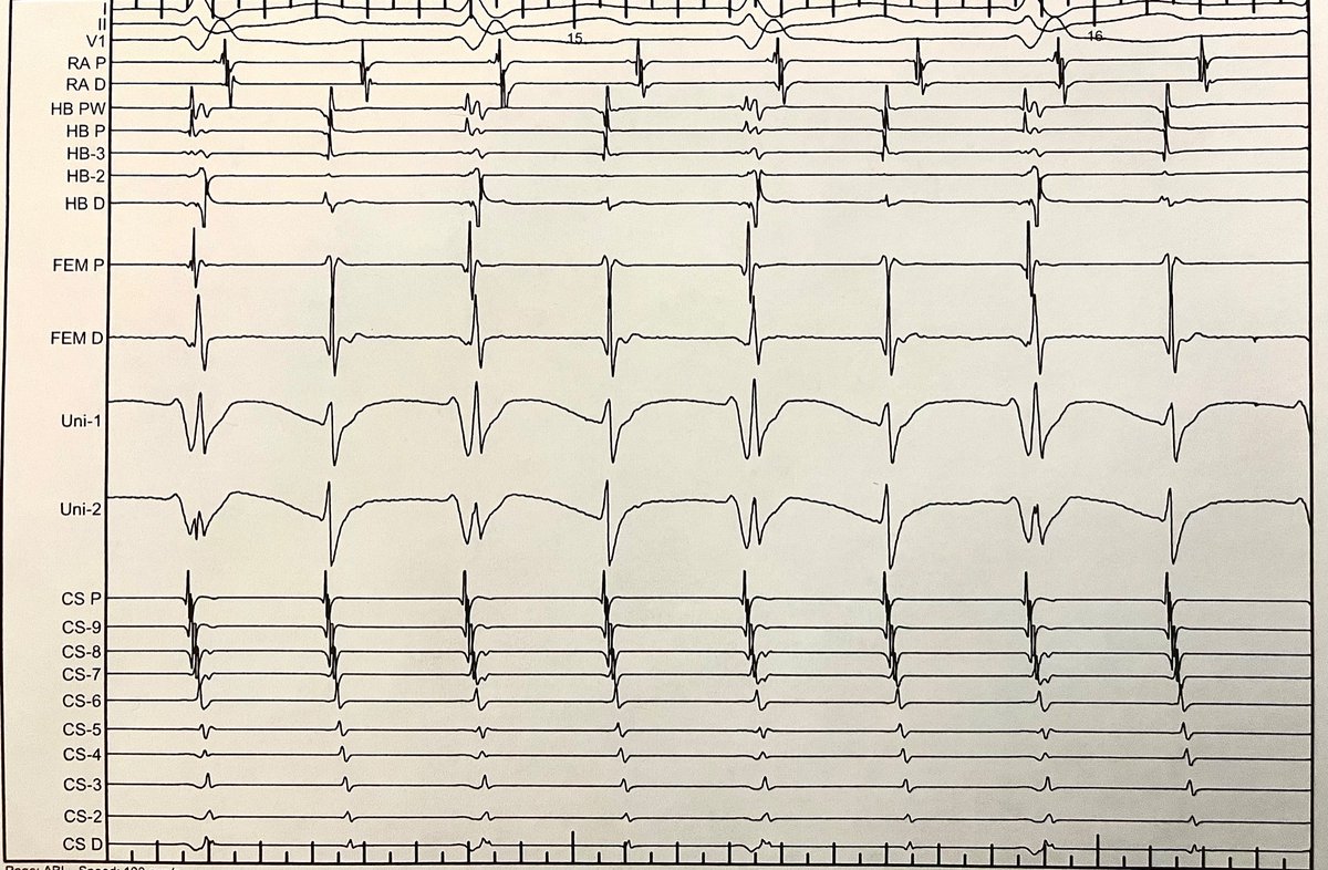 A case of 2:1 AVNRT.