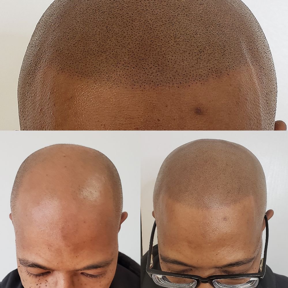 Scalp Micropigmentation Houston & San Antonio, TX (scalppclinic) / Twitter