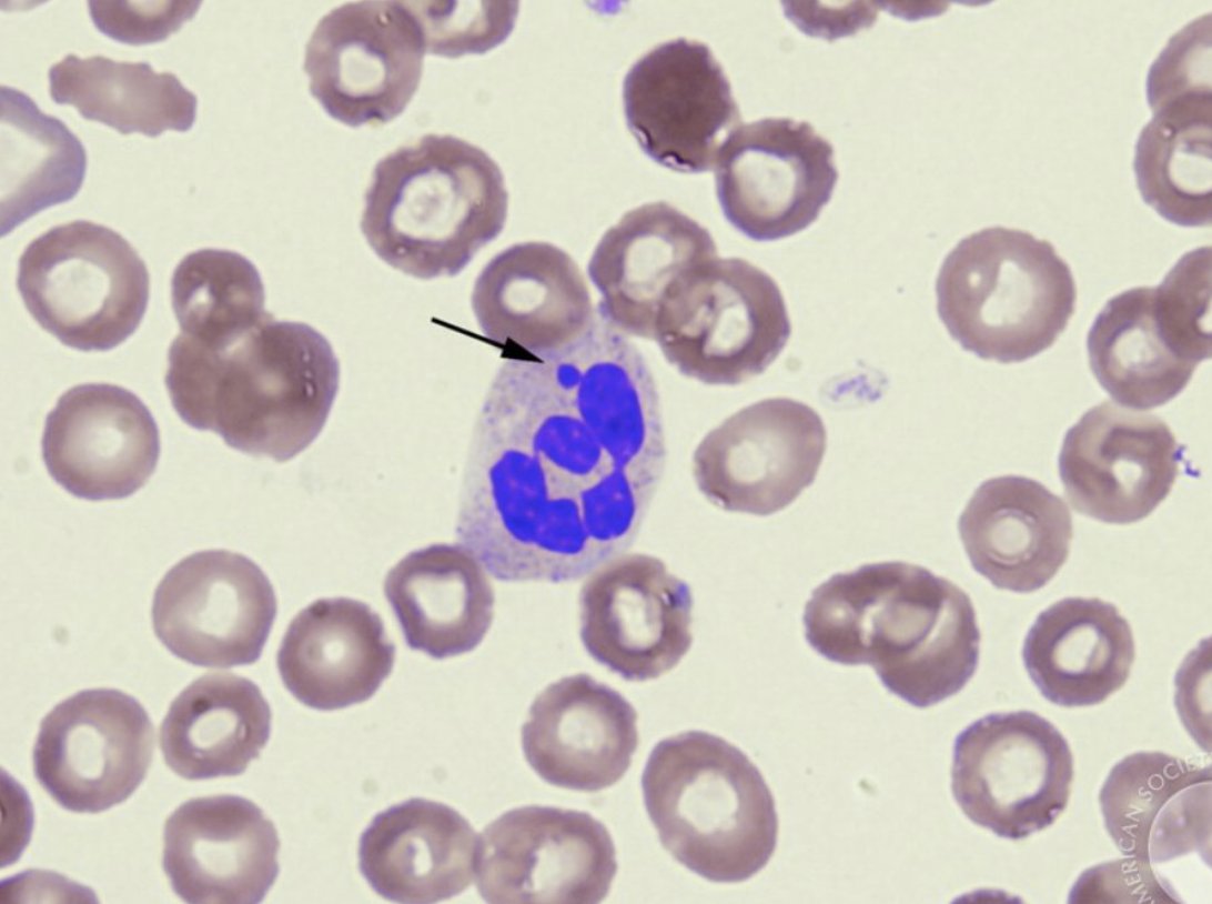 My favorite hematology riddle! Can you answer it? A 30 year old male is evaluated for anemia. His blood smear is pictured below. How is this possible??? [Image from ASH Image bank]