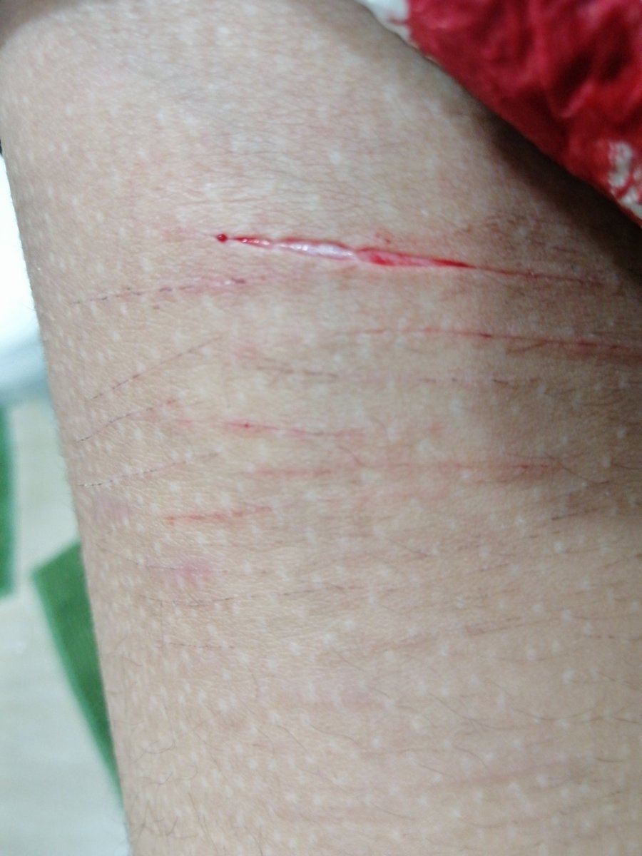 XexSH1's tweet photo. TW SH so uhhh i hit styro
.
.
.
.
.
.
.
.
.
.
shtwt styrotwt ouchietwt selfharmtwt https://t.co/JxLgi2PneL