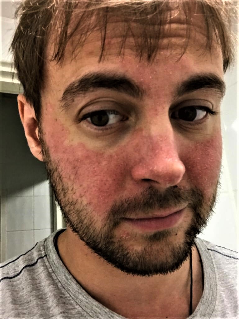 So for years I have had pretty bad skin problems. 

For seemingly no reason my face would start burning &amp; within hours would result in horrible read blotches appearing on my cheeks and nose. 

After years, I have finally worked out why. Come with me on a flakey adventure. Thread: