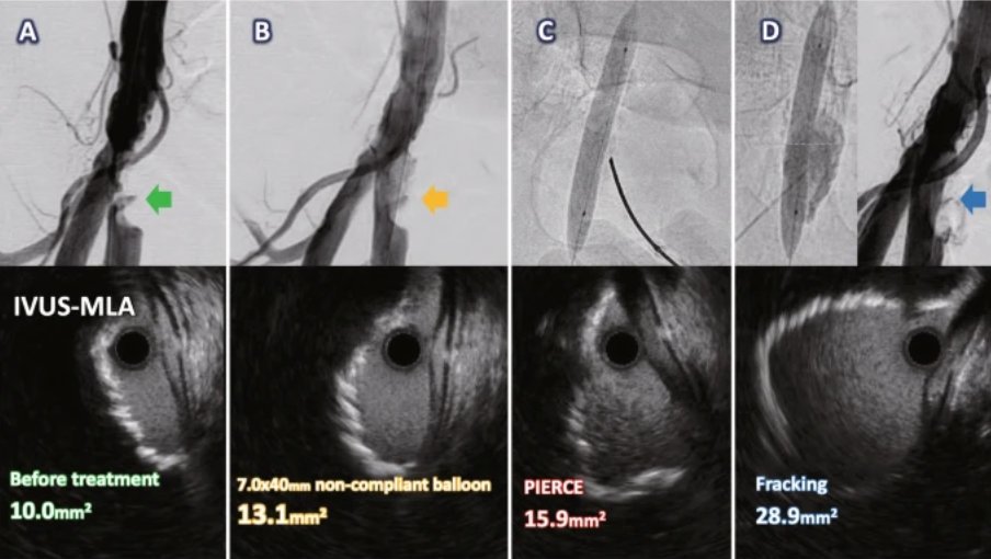 In this #NewTech🔬 classic, the authors described a novel approach to crack deep calcified plaque in the common femoral artery using hydraulic pressure: the fracking technique!

Check it out again for free: 
cvirendovasc.springeropen.com/articles/10.11… #IRad #SundayRead