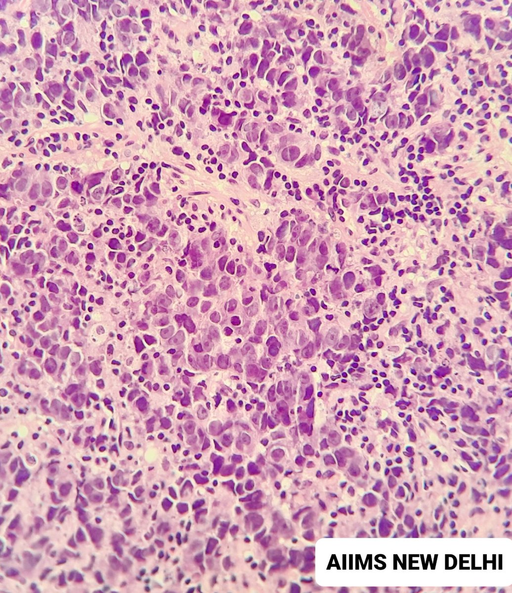 pathognosis22's tweet photo. #Case99 38/F, progressive dysphagia for 4 months, No hoarseness,ECOG 1, UGIE: Growth at 20 cm, Esophageal growth biopsy:? poorly differentiated carcinoma , IHC will follow in thread https://t.co/FupEMZ5n69