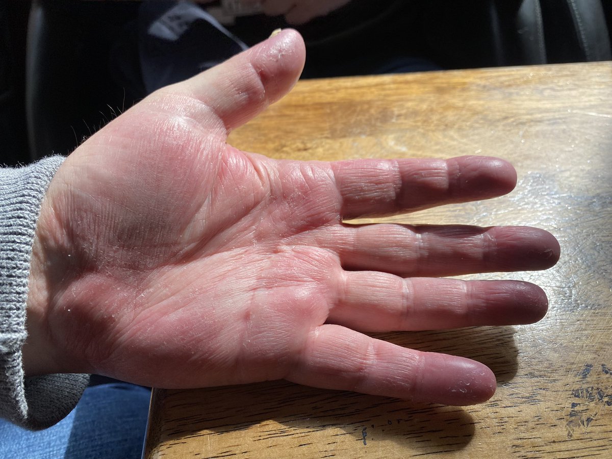 These are my dad’s hands. They are sore, itchy &amp; the nails are starting to come off. His feet are even worse. He has been to 2 different GPs; given a steroid cream by one and antibiotics by the second. Neither have helped. Can anyone diagnose or give any advice, it’s awful to see