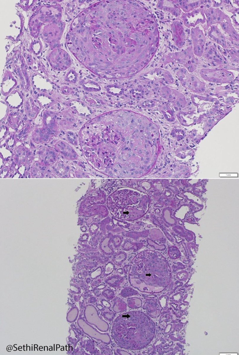 Rush today. Bx result before serology!

Severe necrotizing &amp; crescentic glomerulonephritis (GN), all glomeruli showed crescents (arrow).
IF= linear IgG (3+) along glomerular basement membrane (GBM).

Diagnosis: Anti-GBM GN

16 yr-old with 1-week h/o AKI, Cr 8. Serologies pending.